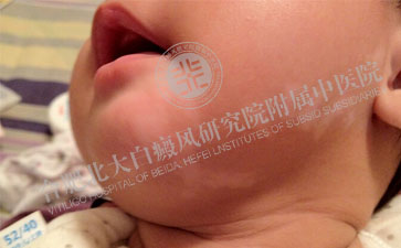白癜风的白斑要怎么诊断呢