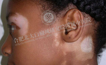 诊断身上的白癜风怎么进行